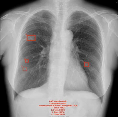 Eirl Chest Nodule Eirlエイル Ai画像診断支援技術 エルピクセル株式会社