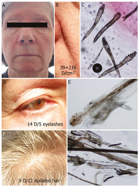 Treat Demodex Mites Rosacea Bios Pics