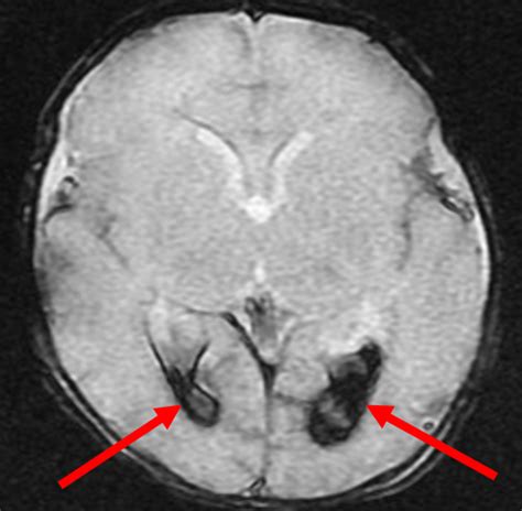 Germinal Matrix Hemorrhage Grading