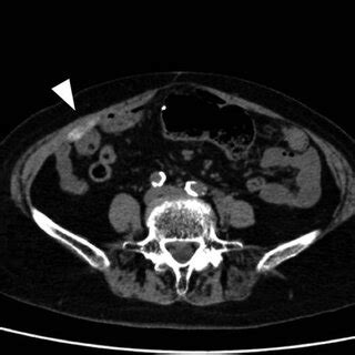 A Axial And B Coronal Abdominal Contrast Enhanced Ct Showed A Bulky