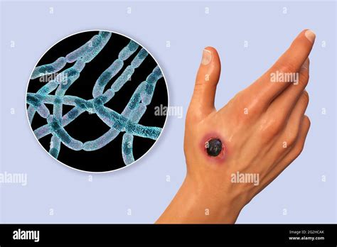 Cutaneous Anthrax Illustration Stock Photo Alamy