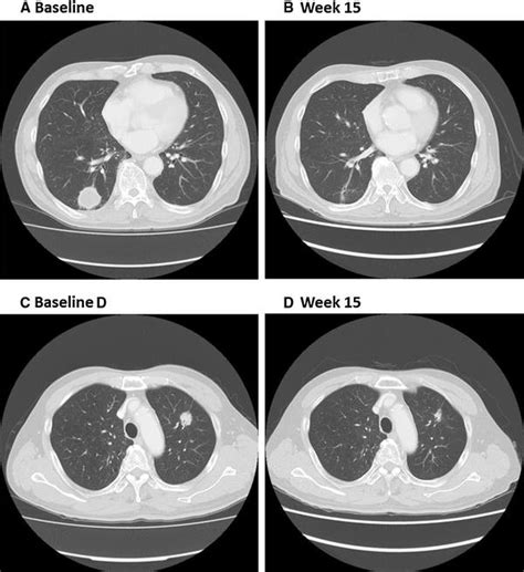 Partial Response To Veliparib Mg Bid And Carboplatin And Paclitaxel