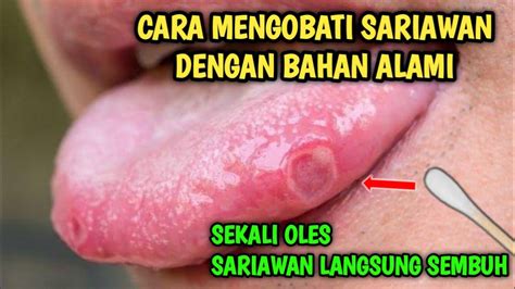 Cara Mengobati Sariawan Cara Menyembuhkan Sariawan Youtube