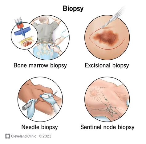 Biopsy: Types Of Biopsy Procedures Used To Diagnose Cancer, 47% OFF