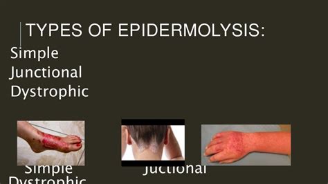 Epidermolysis Bullosa