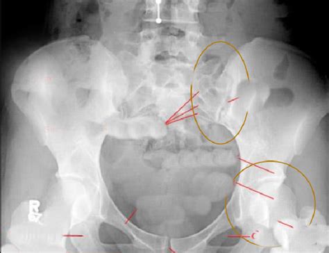 RT 123 Chapter 8 Pelvis Hip Pelvis Radiograph Diagram Quizlet