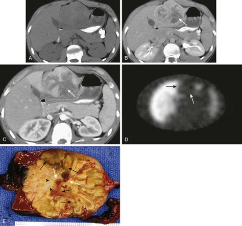 Malignant Tumors Of The Liver Radiology Key