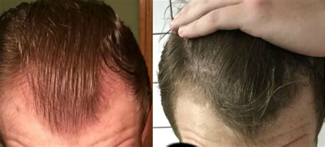 Results From Taking Finasteride And Minoxidil Photo From Reddit