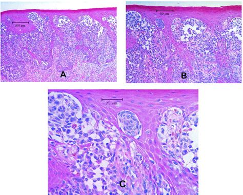 Intraoral Melanoma Long Term Follow Up And Implication For Dental