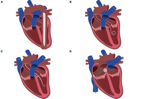 Left Ventricular Unloading Methods During Va Ecmo Treatment A