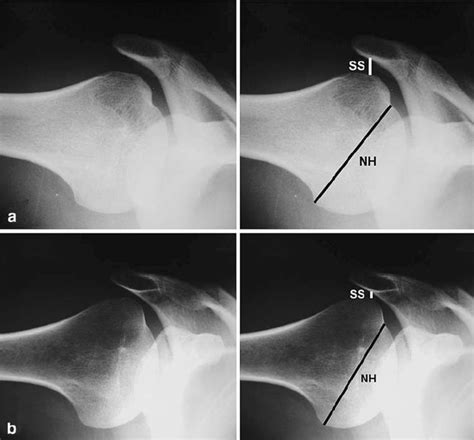 The Subacromial Space Ss And Neck Of Humerus Nh Lines For