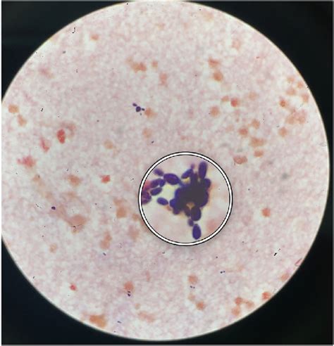 Peritoneal Fluid Gram Stain On Hd 13 Showing Budding Yeast Later