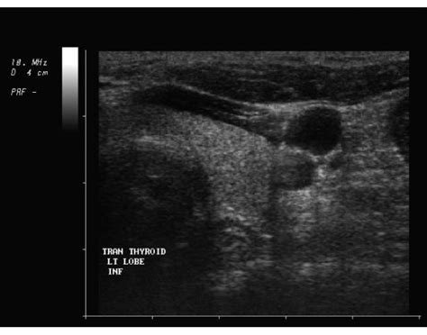 Thyroid Ultrasound 16 Quiz