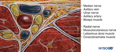 Bloc Du Plexus Brachial Axillaire Technique Des Rep Res Et Du