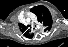 Scimitar Syndrome APPLIED RADIOLOGY