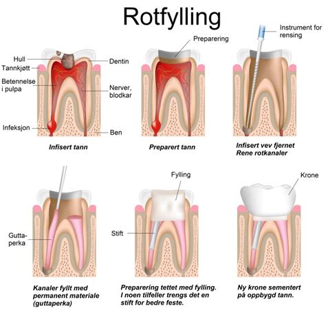 Rotfylling Pris Alt Om Rotfylling Og Behandling