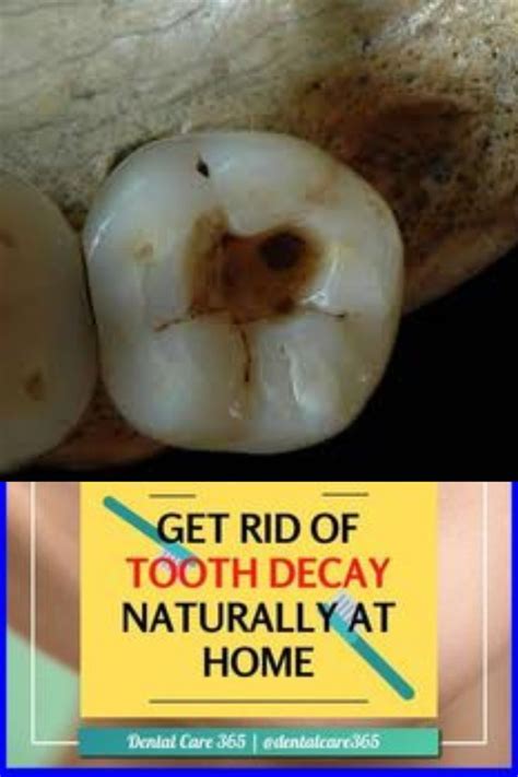 Get Rid Of Tooth Decay Naturally At Home Oral Care For U Tooth