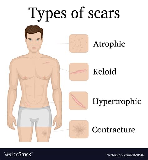 Types Of Scars Royalty Free Vector Image Vectorstock