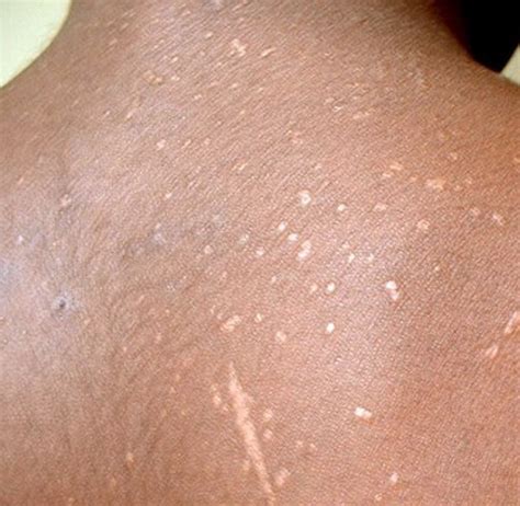 Hiv Rash Symptoms Pics And Treatment 19512 Hot Sex Picture