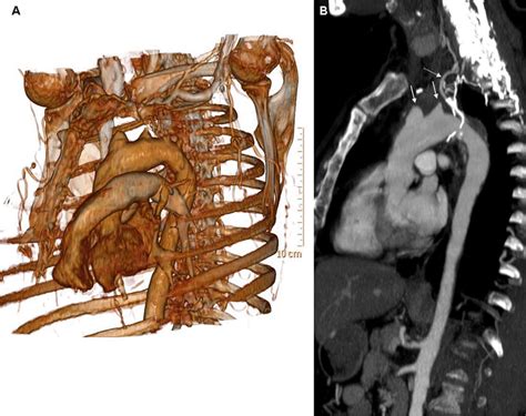 Volume Rendered Cta Image Left Anterior Oblique Orientation Depicting Download Scientific