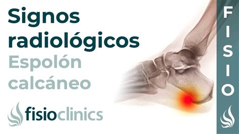 Espol N Calc Neo Signos Radiol Gicos Fisioclinics Palma De Mallorca