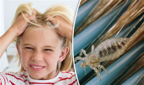 Head lice WARNING: Increasing number of parents REFUSING to treat infestations | Express.co.uk