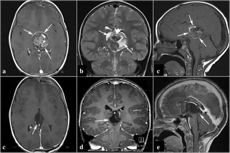 Preoperative Mris Of Case 1 Ac A Axial Section T1 Weighted Images