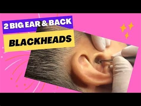 Relax With 2 Big BlackHeads Removal In Ear And Back, Pimple Popping And ...