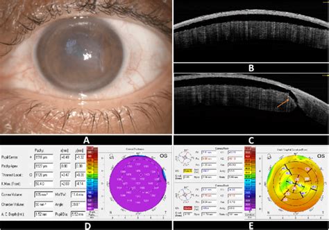 Preoperative Examination A Slit Lamp Image B Oct Image And Download Scientific Diagram