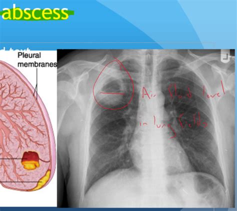 Pneumonia Pulm Exam 3 Flashcards Quizlet