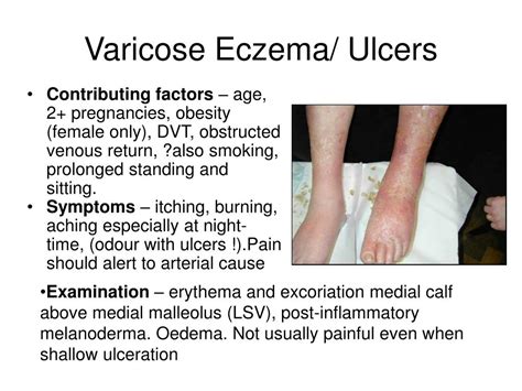 PPT - Varicose Eczema/ Ulcers PowerPoint Presentation - ID:147725