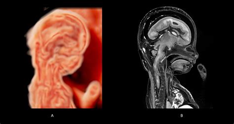 19 Weeks Gestation - 3D Human Development