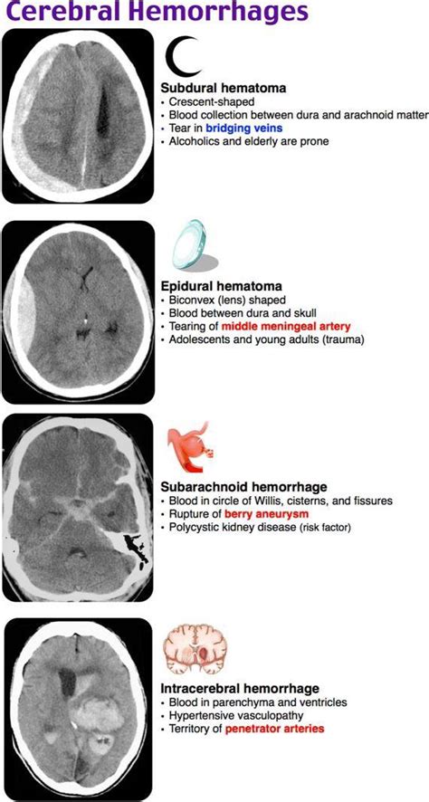 Different Types Of Cerebral Hemorrhages Rcoolguides