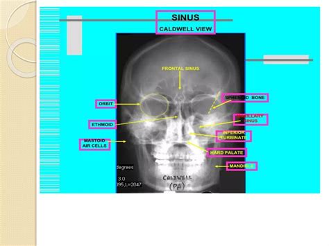 Radiology Of Nose And Paranasal Sinuses Ppt