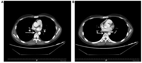 Esophageal Metastasis Secondary To Extranodal Nasal Type Natural Killer