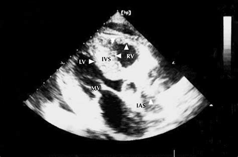 Figure1 Stiff Heart Syndrome Cmaj