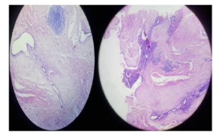 Cesarean scar endometriosis: A case report