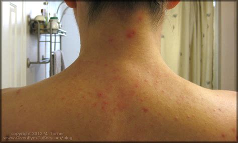 allergic reaction to shampoo - pictures, photos