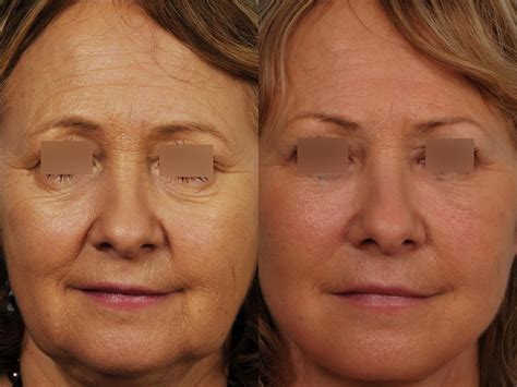 Photos De Rajeunissement Facial Avant Et Après