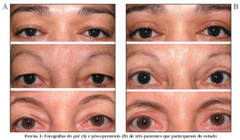 Scielo Brasil Avalia O Do Impacto Da Blefaroplastia Superior Na