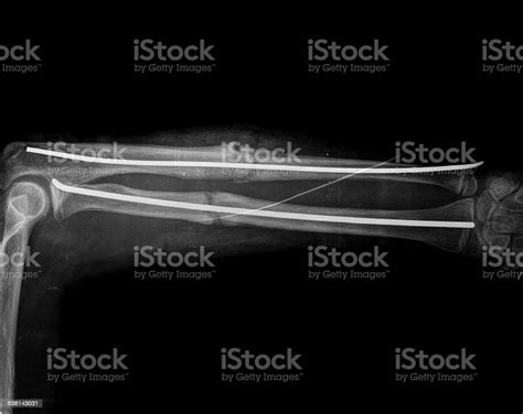 Broken Arm With Screw Stock Photo Download Image Now Broken Arm X