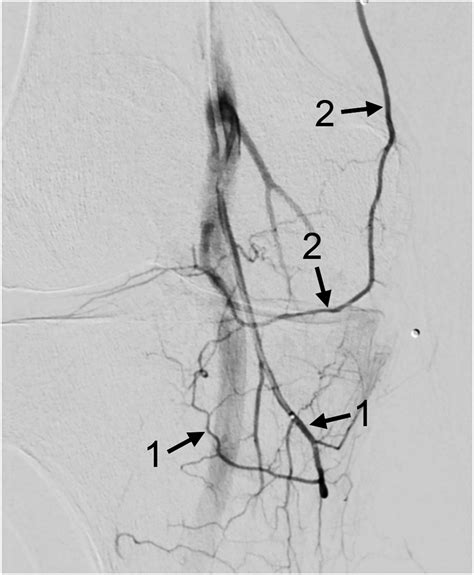 Genicular Artery Embolization A Review Of Essential Anatomic