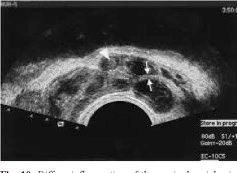 Figure From Clinical Applications Of Transrectal Ultrasound In The