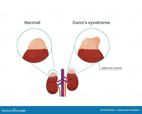 Adrenal Gland Normal Anatomy and Adrenal Adenoma Illustration Stock Vector - Illustration of ...