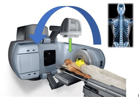 Lung Cancer Radiation Therapy The Basics And Complexities Better