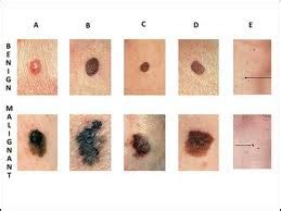 skin cancers sebastopol specialty center