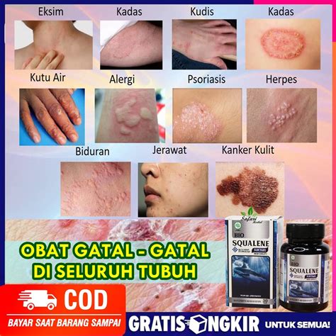 Jual Obat Gatal Budug Kudis Kadas Kurap Gatal Gatal Di Tubuh Obat