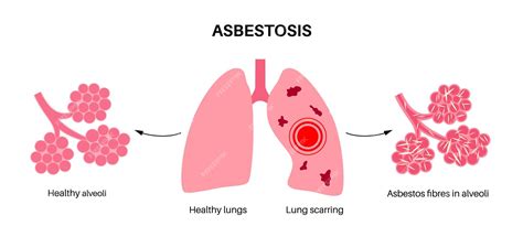 Premium Vector Asbestosis Lung Disease