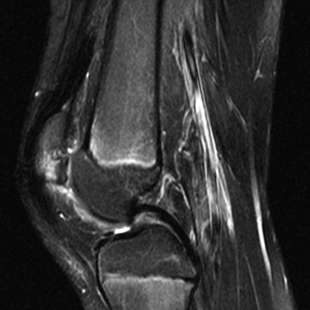 Chondromalacia patellae | Radiology Reference Article | Radiopaedia.org