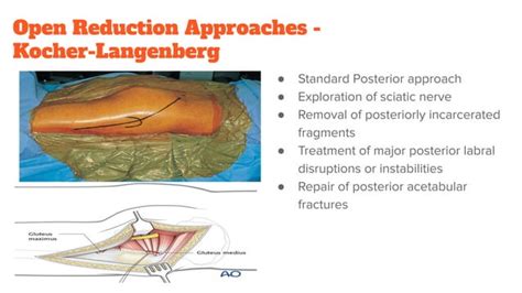 Emergency Management Of Hip Dislocations Pelvic Fractures Pdf